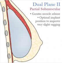 L’IMPLANT EST-IL PLACÉ DEVANT OU DERRIÈRE LE MUSCLE ?