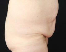 L'ABDOMINOPLASTIE EST-ELLE PRISE EN CHARGE ?