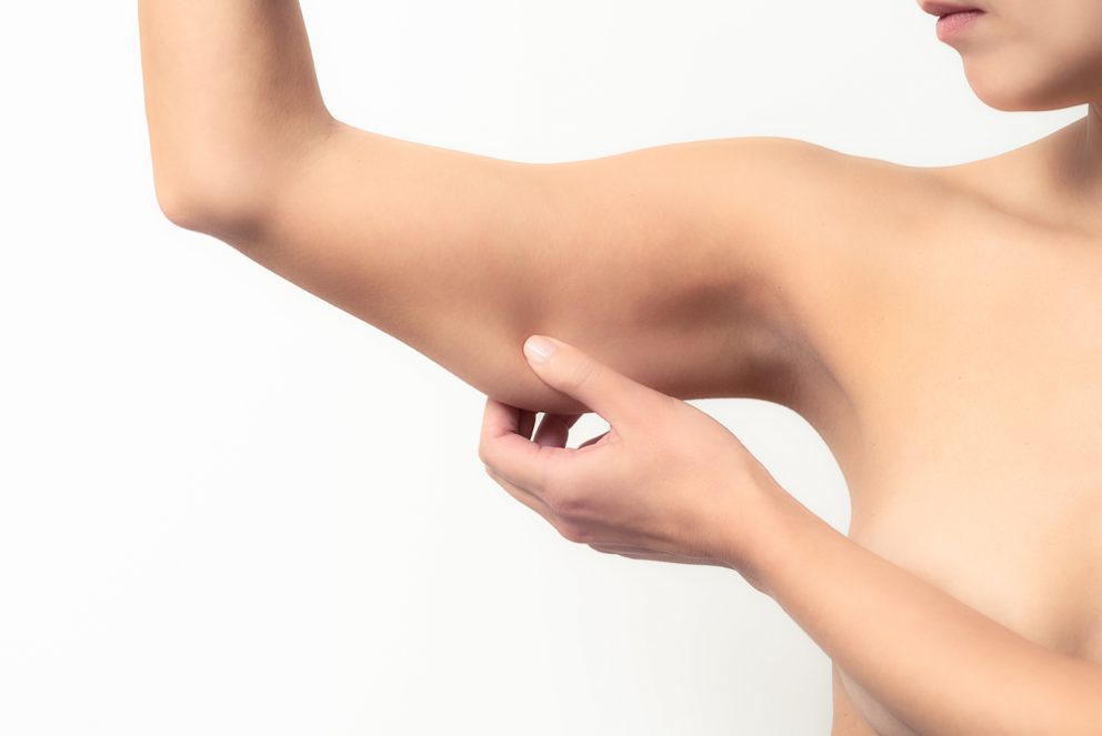 Voir Lifting des bras ou brachioplastie