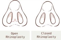QU'EST CE QUE LA RHINOPLASTIE FERMÉE OU OUVERTE ?