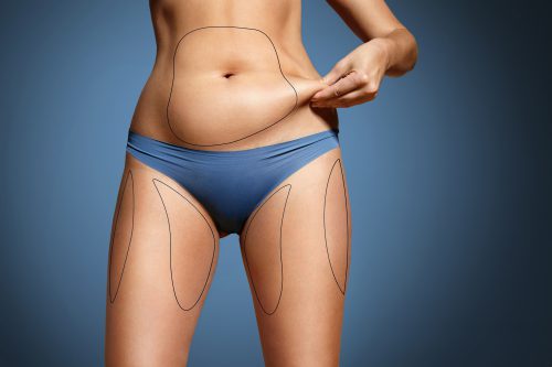 Voir Liposuccion douce à Paris : tout savoir !