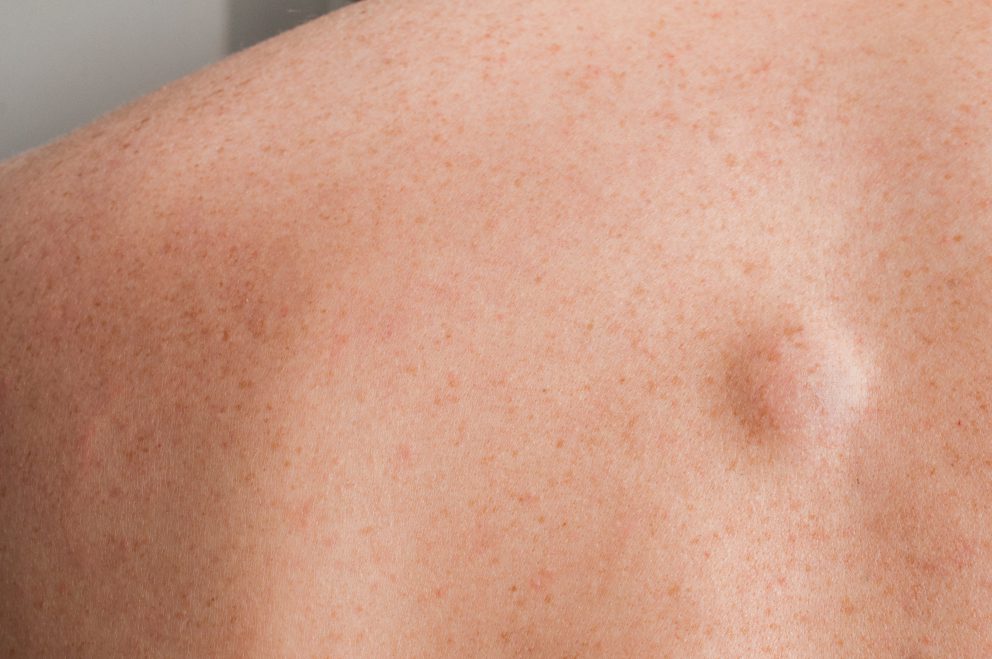 Voir Chirurgie dermatologique