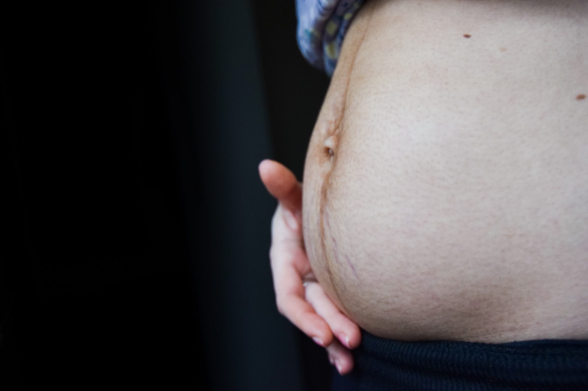Diastasis & abdominoplastie : chirurgie réparatrice ventre