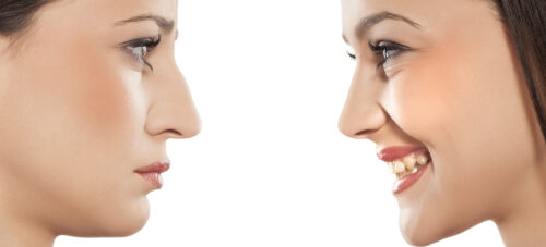 Voir Rhinoplastie prix : combien coûte une chirurgie esthétique du nez ?